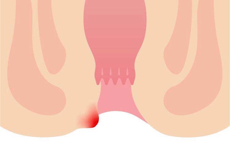 痔核（いぼ痔）のイメージ画像
