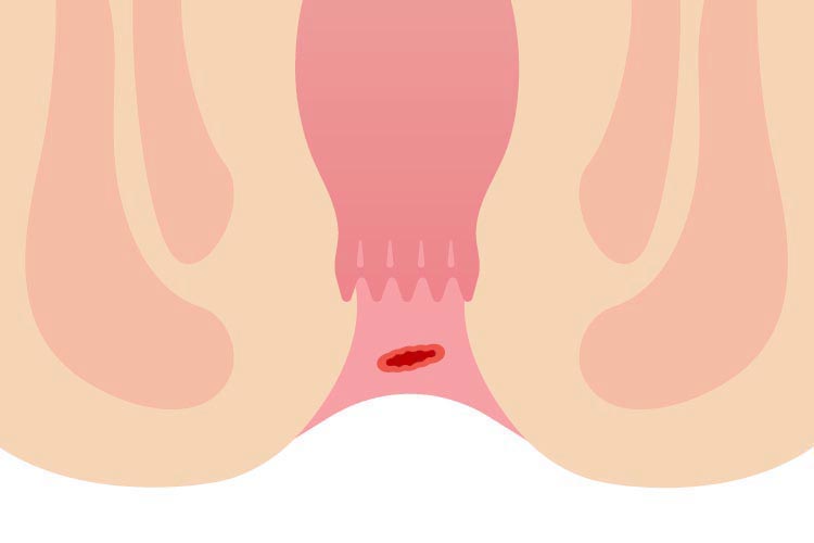 裂肛（きれ痔）のイメージ画像