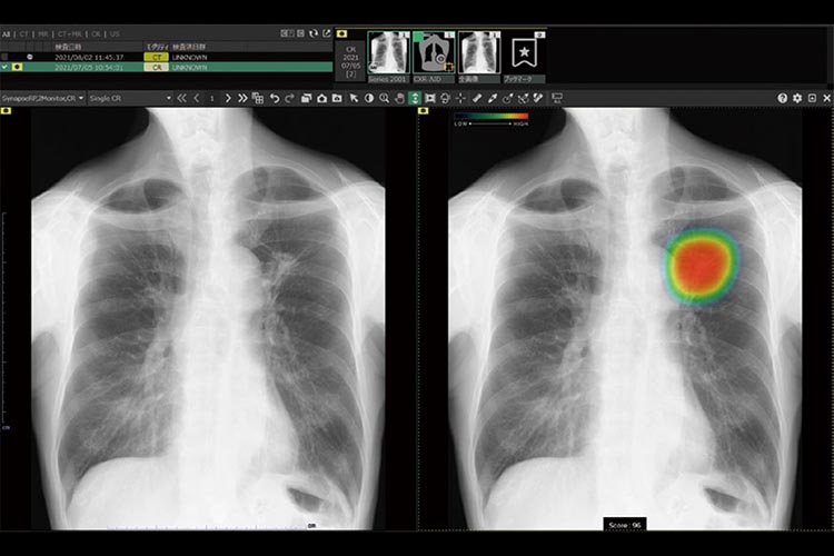 胸部レントゲン画像