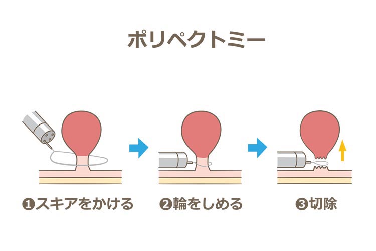 コールドスネアポリペクトミー（CSP）のイメージ写真