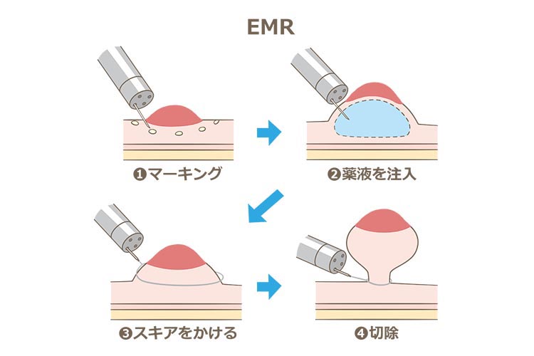 大腸粘膜切除術（EMR）のイメージ写真