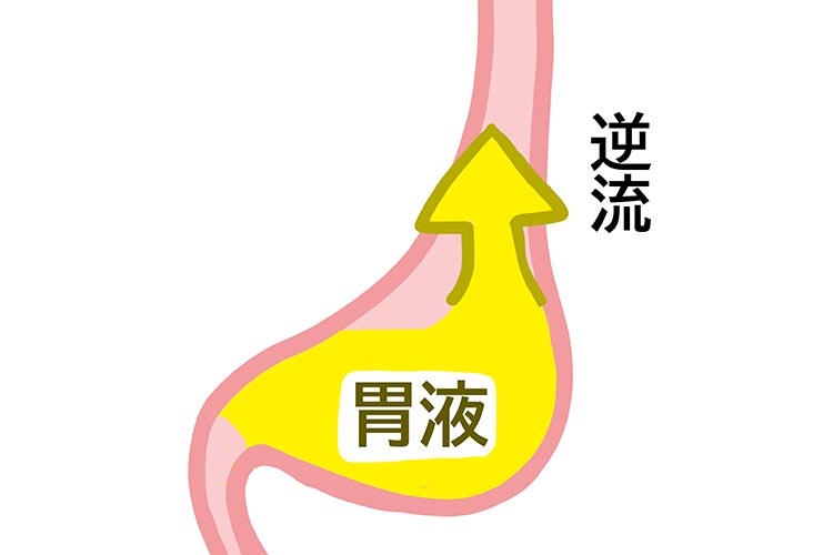 胃潰瘍のイメージ写真